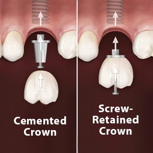 comparison of a screw-retained vs a cement-retained dental implant crown