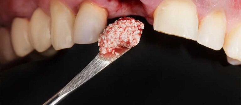 Corticocancellous bone graft for socket preservation