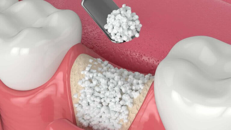 Dental bone graft procedure