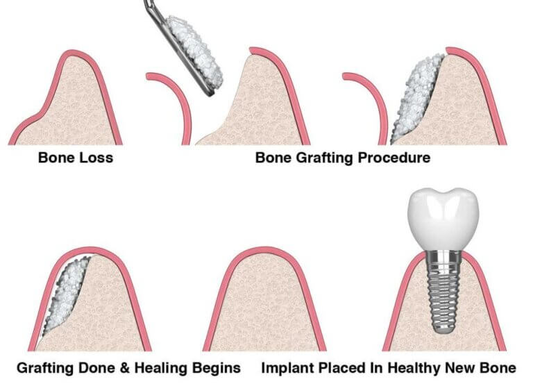 Dental bone graft procedure to reconstruct bone width