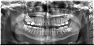 panoramic x-ray