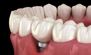 Peri-implantitis showing exposed dental implant threads
