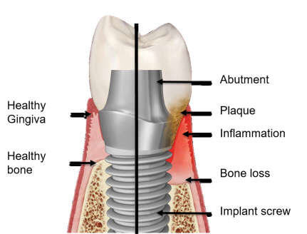Comparison of healthy tissues around a dental implant to peri-implantitis