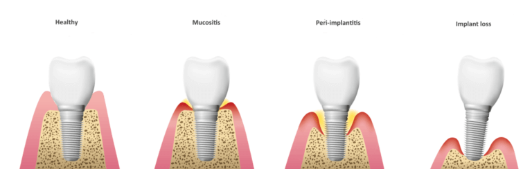 Progression of peri-implantitis