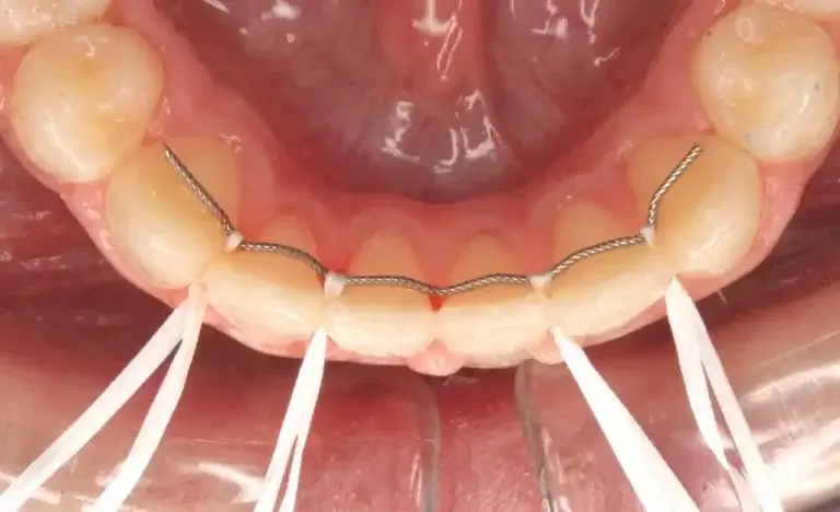 Broken retainer discount