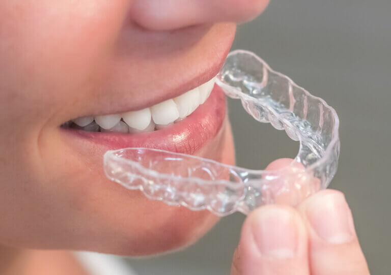 Removable retainers