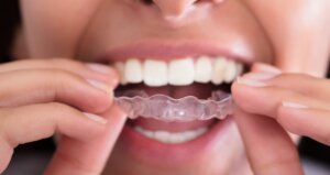 Removable retainers