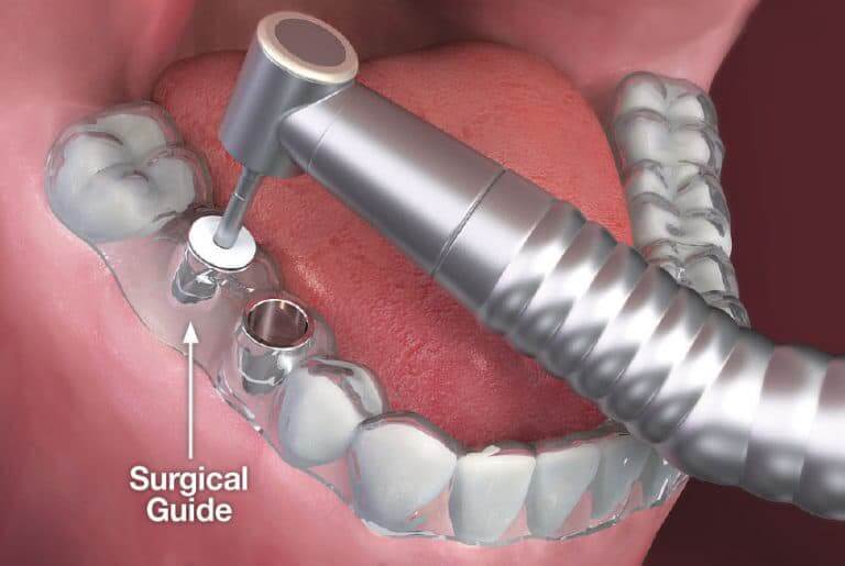 Surgical guide for dental implants