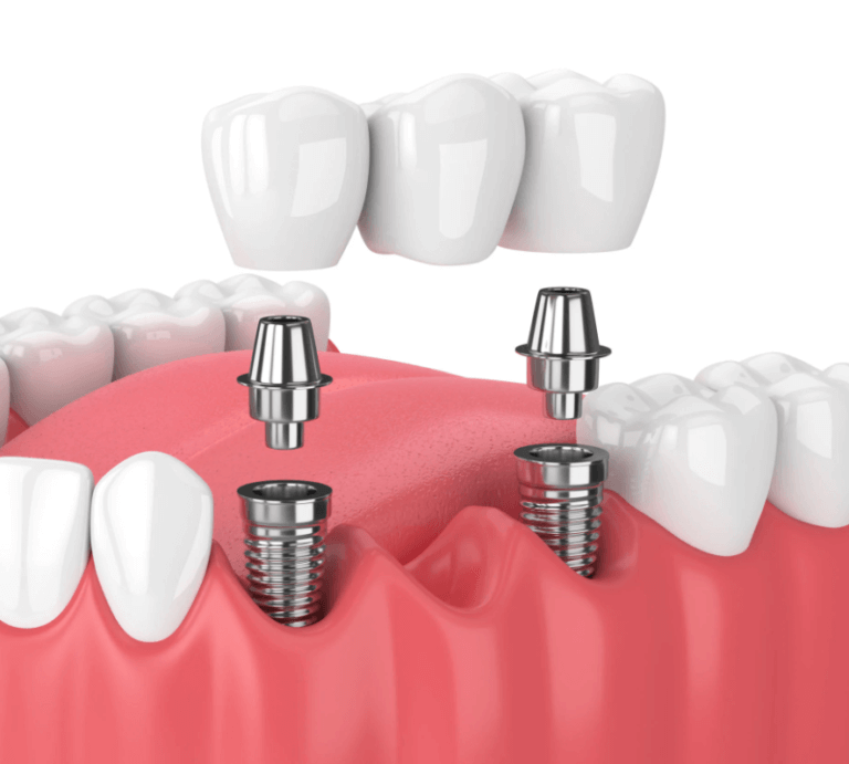 3-unit dental implant bridge