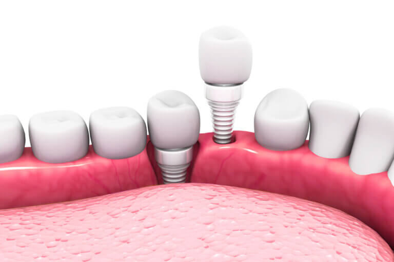 Zirconia vs titanium dental implant in jaw