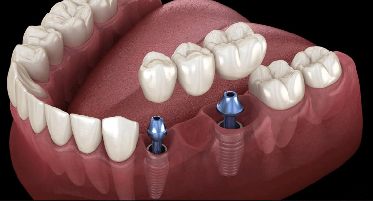 dental implant bridge