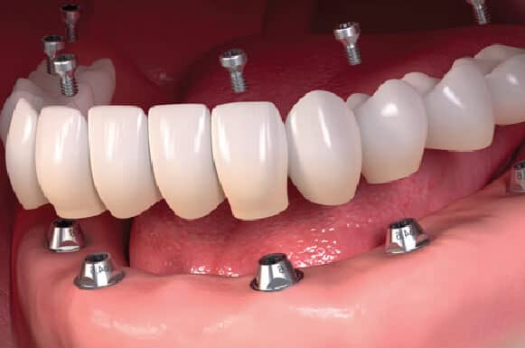 dental implant bridge