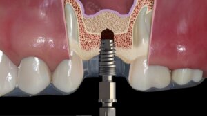 Indirect sinus lift