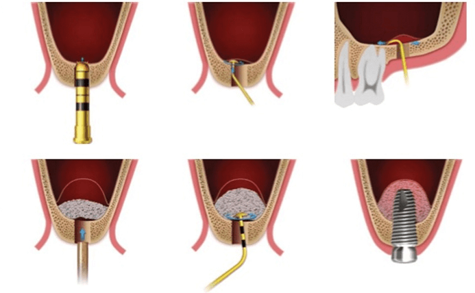 Indirect sinus lift steps