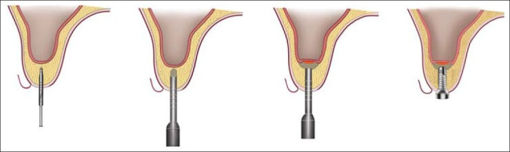 Indirect sinus lift steps