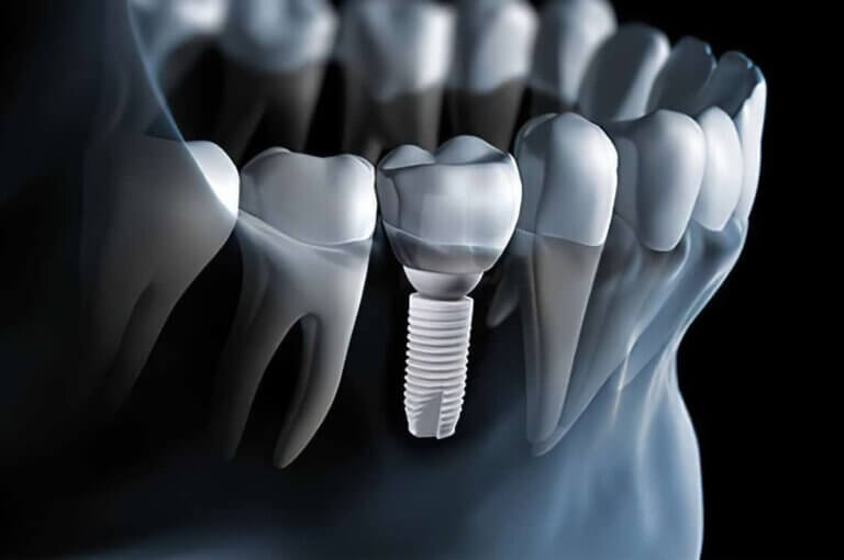 Zirconia dental implant in jaw