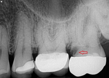 Tooth decay under crown xray
