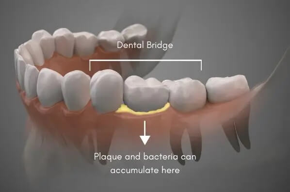 Cavity Under A bridge