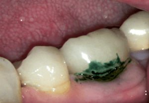 Tooth decay under crown