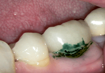 Tooth decay under crown