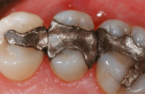 dental amalgam filling replacement