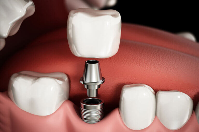 dental implant with crown attached