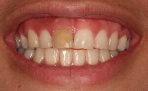 discolored tooth