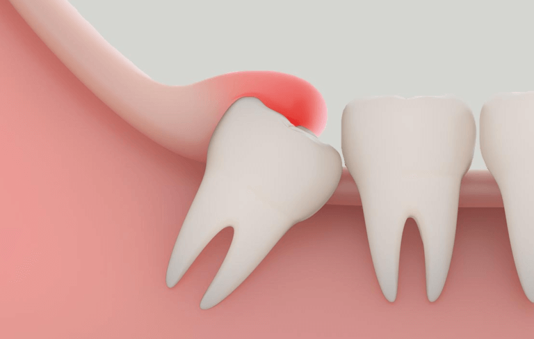 pericoronitis