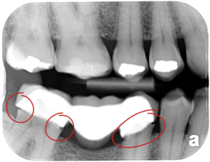 Dental bridge open margin