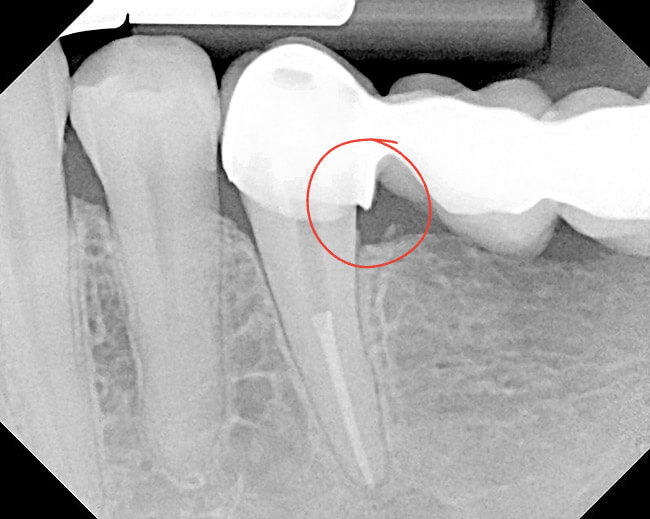 dental bridge overhang