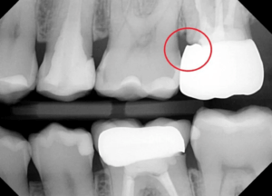 Dental crown open margin