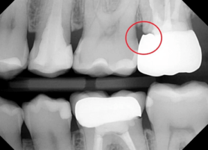 Porcelain Fused To Metal Dental Crown - Atlas Dental Toronto