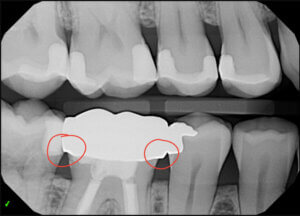 Dental Crown Overhanging Margin