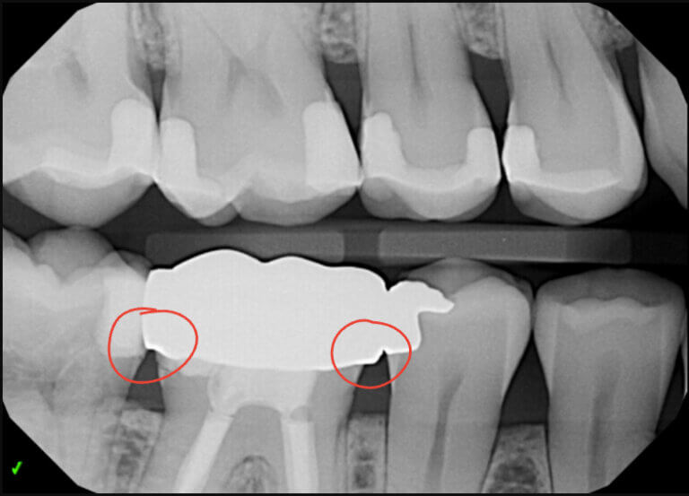 Dental Crown Overhanging Margin