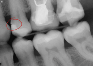 Dental filling open margin