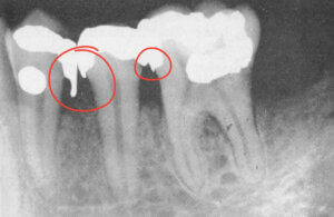 Dental Filling Overhanging Margin