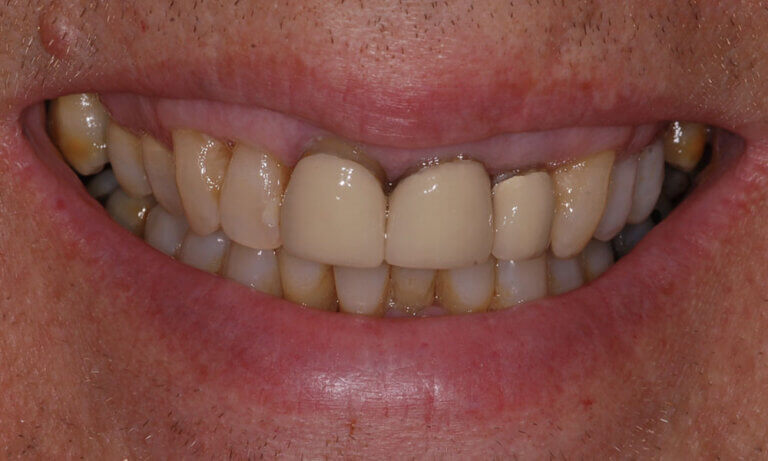 Dental veneer open margin