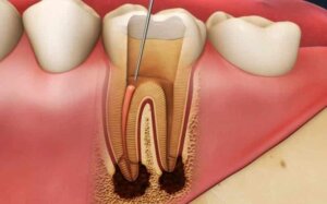 Failed root canal treatment