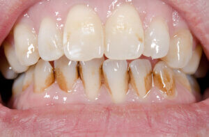 Teeth staining