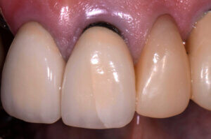 Tooth decay under a dental veneer