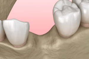 Dental bone loss