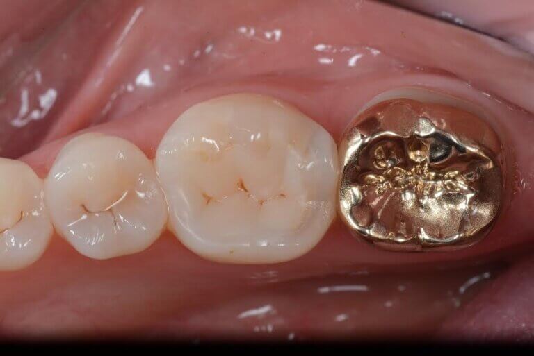 gold dental crown