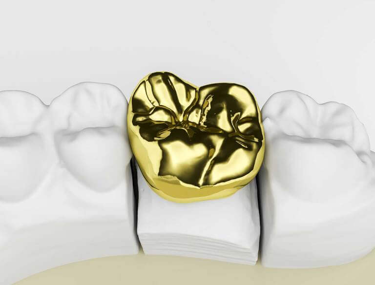 gold dental crown