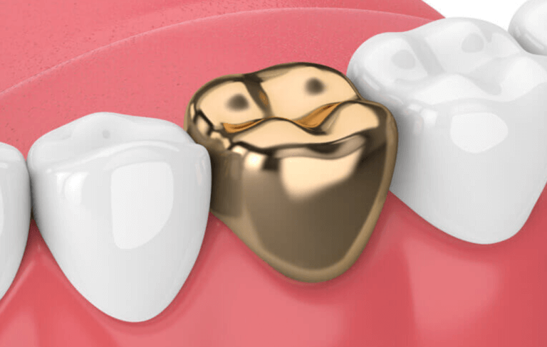 Gold dental crown