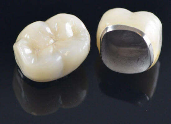 pfm dental crown