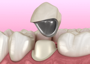 porcelain fused to metal dental crown