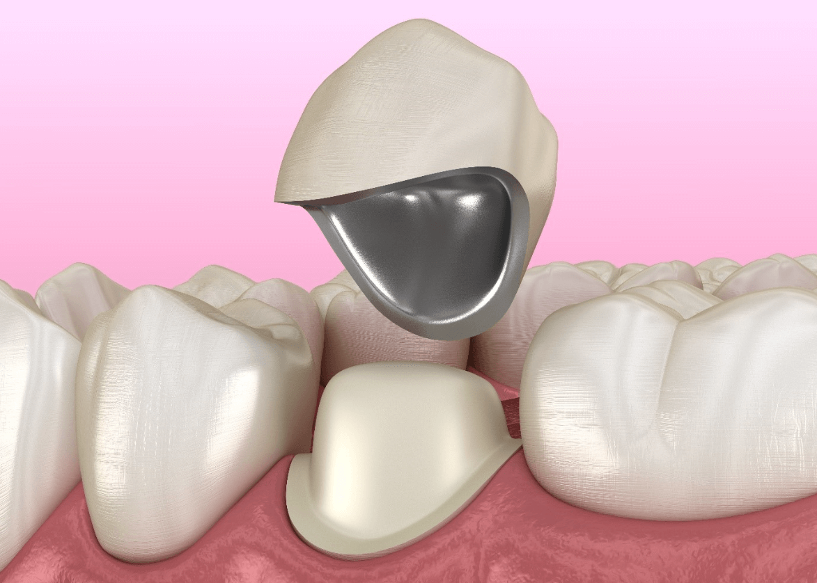 Porcelain Fused To Metal Dental Crown - Atlas Dental Toronto