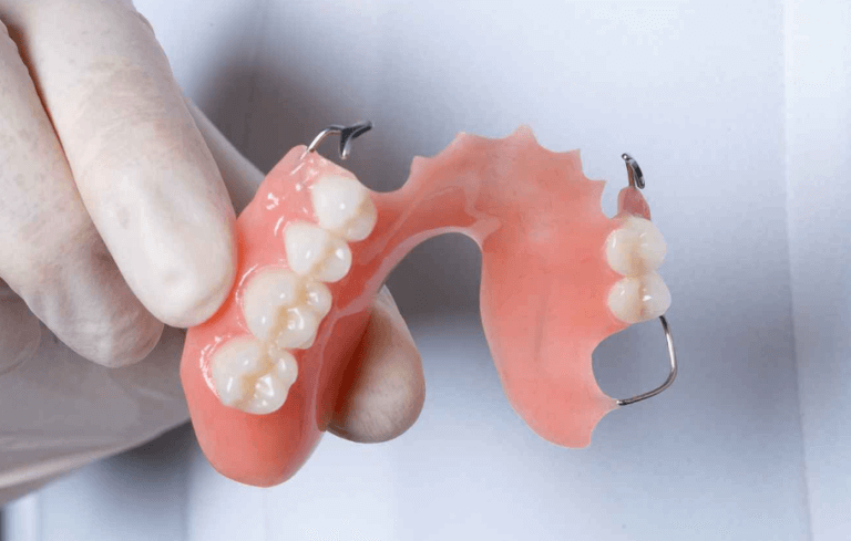 Acrylic partial denture