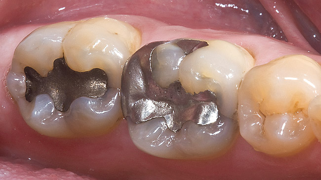 Amalgam filling