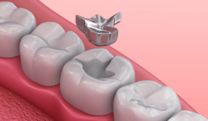 Amalgam filling